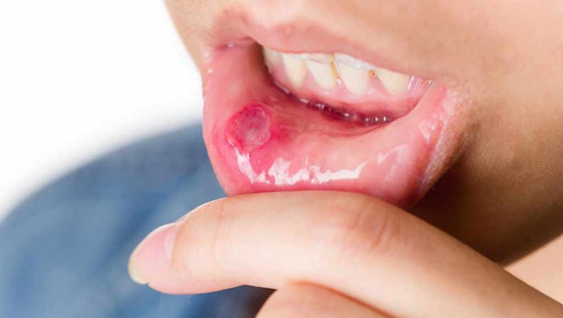 درمان خانگی زخم های دهان